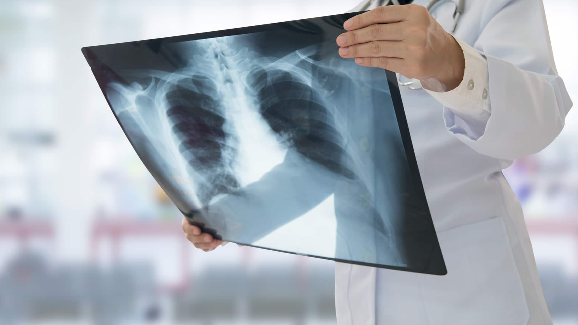woman pulmonologist wearing white medical coat holds an x-ray image of a human chest and lung for examination