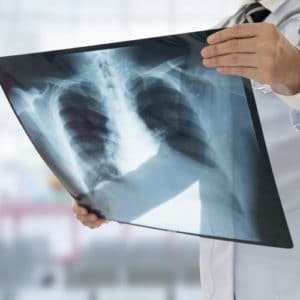 Pulmonologist looking at lung x-ray