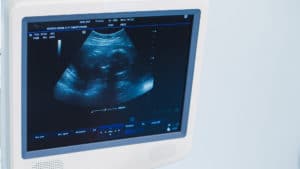 sonography careers